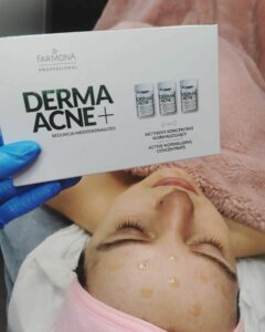 customer with a cream on face and box of derma acne cream treatment