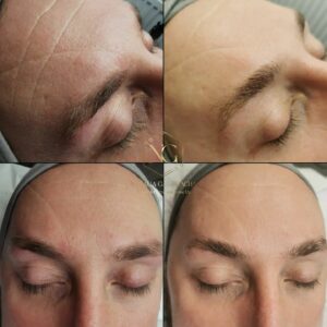 four pictures before and after effect on skin, visible change in a amount of wrinkles aesthetics by natalia