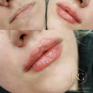 lip filler effect on woman, visible effect, pictures before and after