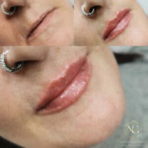 lip filler effect visible on woman before and after