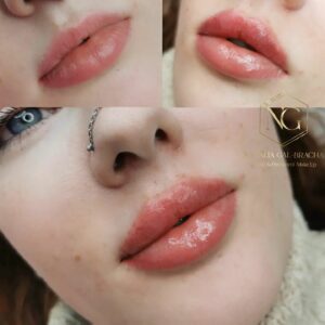 effective lip filler pictures before and after, aesthetics